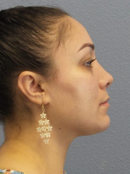 Rhinoplasty Before & After Patient #532