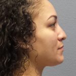 Rhinoplasty Before & After Patient #532