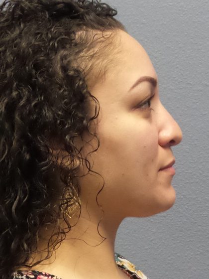 Rhinoplasty Before & After Patient #532