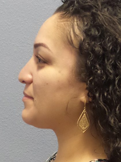 Rhinoplasty Before & After Patient #532