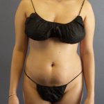 Liposuction Female Before & After Patient #1170