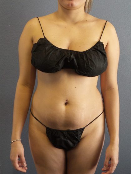 Liposuction Female Before & After Patient #1170