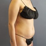 Liposuction Female Before & After Patient #1170