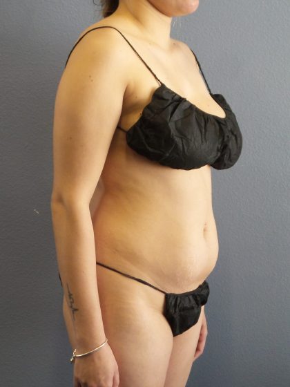 Liposuction Female Before & After Patient #1170