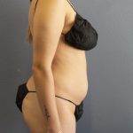 Liposuction Female Before & After Patient #1170