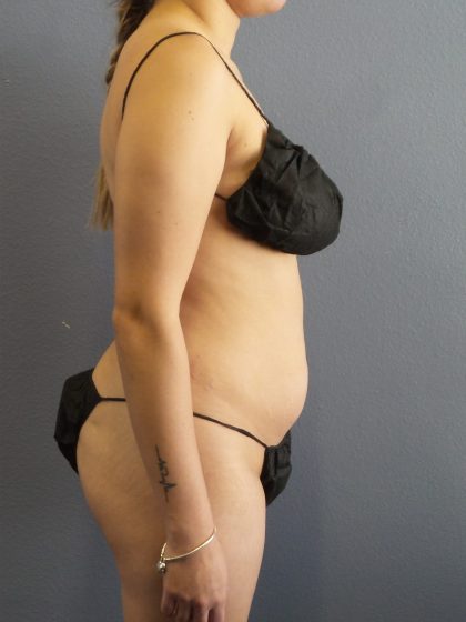 Liposuction Female Before & After Patient #1170