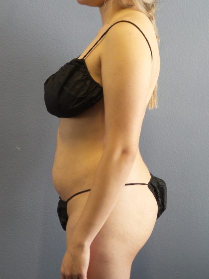 Liposuction Female Before & After Patient #1170