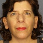 Facelift Before & After Patient #965
