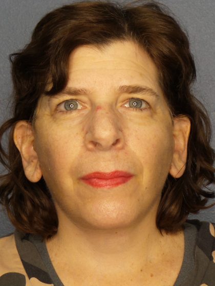 Facelift Before & After Patient #965