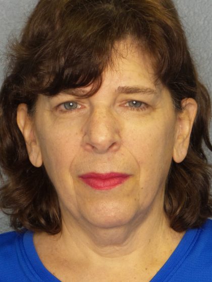 Facelift Before & After Patient #965