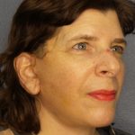 Facelift Before & After Patient #965