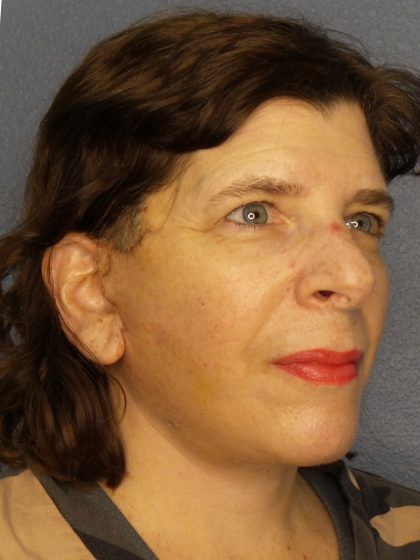 Facelift Before & After Patient #965