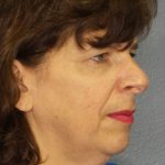 Facelift Before & After Patient #965