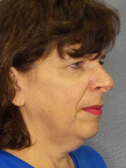 Facelift Before & After Patient #965