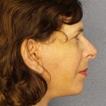 Facelift Before & After Patient #965
