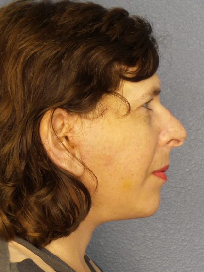 Facelift Before & After Patient #965