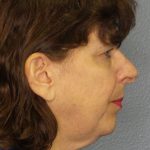 Facelift Before & After Patient #965