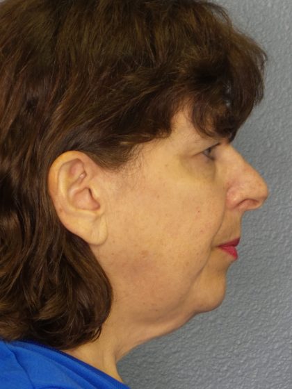 Facelift Before & After Patient #965