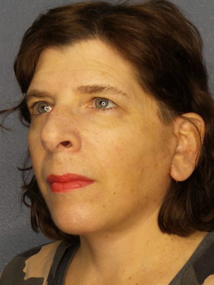 Facelift Before & After Patient #965