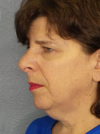 Facelift Before & After Patient #965