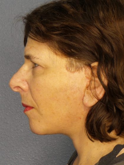 Facelift Before & After Patient #965