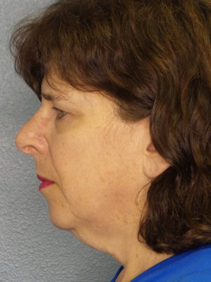Facelift Before & After Patient #965