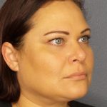 Liposuction Female Before & After Patient #1128