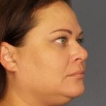 Liposuction Female Before & After Patient #1128
