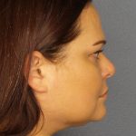 Liposuction Female Before & After Patient #1128