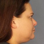 Liposuction Female Before & After Patient #1128