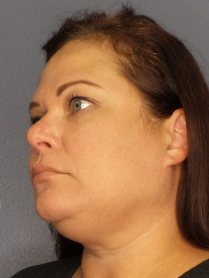 Liposuction Female Before & After Patient #1128