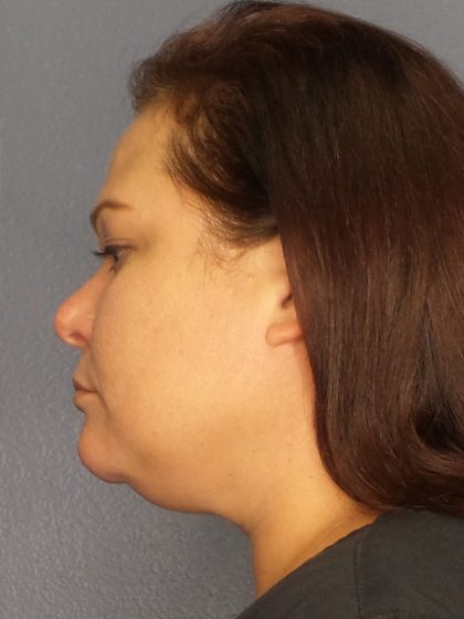 Liposuction Female Before & After Patient #1128