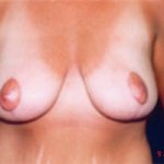 Breast Reduction Before & After Patient #2441
