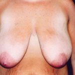 Breast Reduction Before & After Patient #2441