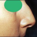 Rhinoplasty Before & After Patient #2455