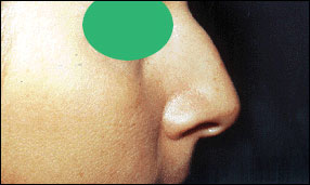 Rhinoplasty Before & After Patient #2455