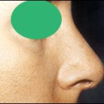 Rhinoplasty Before & After Patient #2455