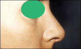 Rhinoplasty Before & After Patient #2455