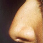 Rhinoplasty Before & After Patient #2456