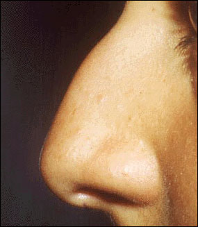 Rhinoplasty Before & After Patient #2456