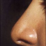 Rhinoplasty Before & After Patient #2456