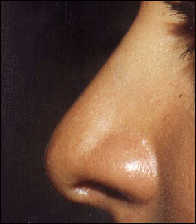 Rhinoplasty Before & After Patient #2456