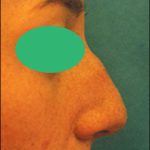 Rhinoplasty Before & After Patient #2457