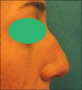 Rhinoplasty Before & After Patient #2457