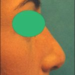 Rhinoplasty Before & After Patient #2457