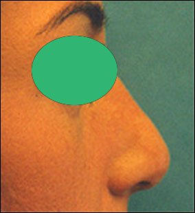 Rhinoplasty Before & After Patient #2457