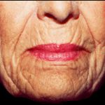 Skin Contouring Before & After Patient #2458