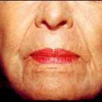 Skin Contouring Before & After Patient #2458