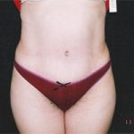 Abdominoplasty Before & After Patient #2402