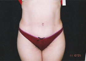 Abdominoplasty Before & After Patient #2402